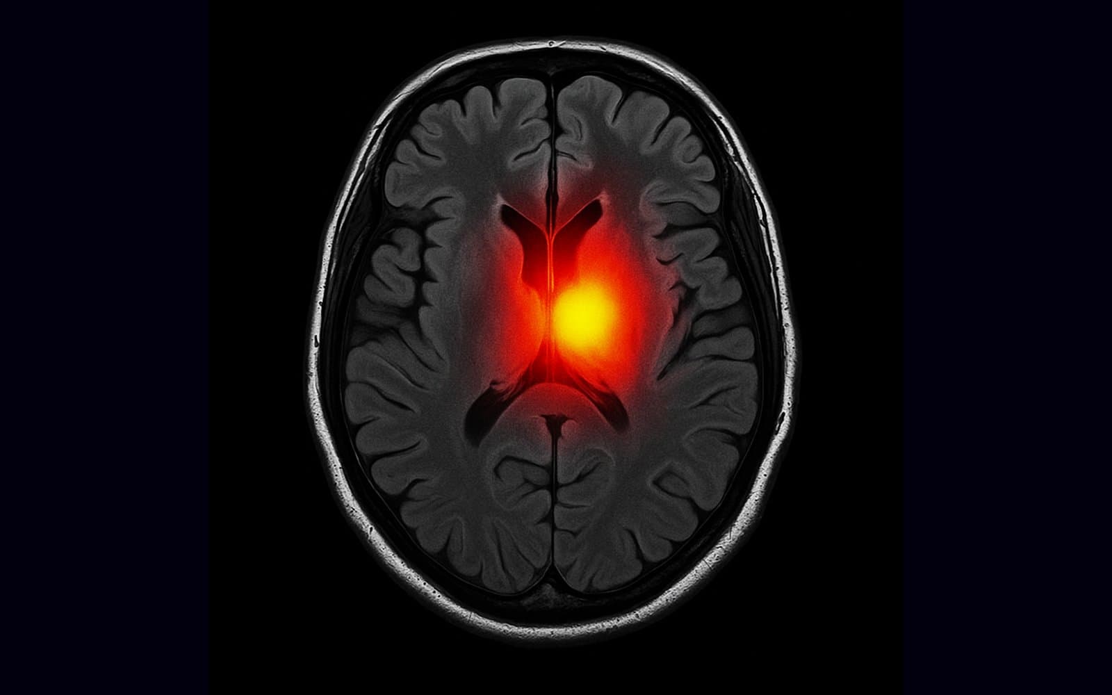 MRI Brain Tumor Recognition